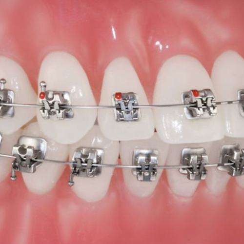 Clips / Braces - Thillai Dental Care